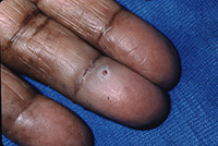 Pyogenic granuloma